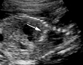 Ultrasonogram of needle placement (arrow) into the fetal thorax.