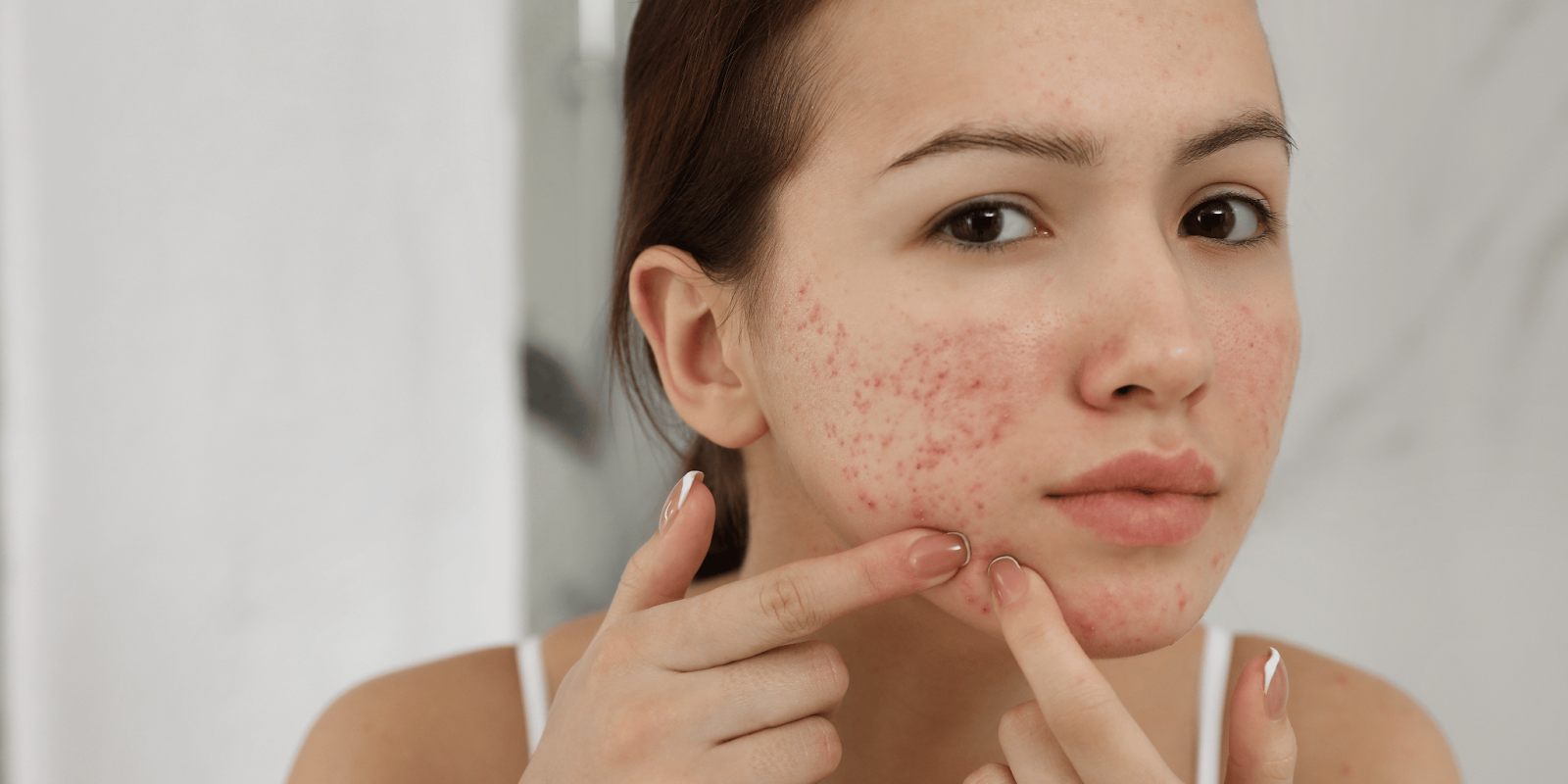 does vitamin c help acne