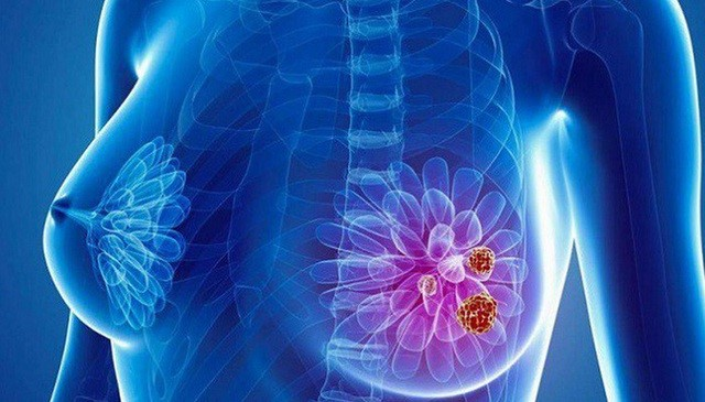 Những kiến thức về ung thư vú mà bạn cần biết