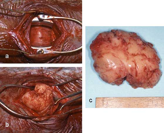 Remoción de un rabdomioma intratraqueal en decúbito dorsal: traqueotomía (a), remoción de la neoplasia (b),  tejido removido (c).
