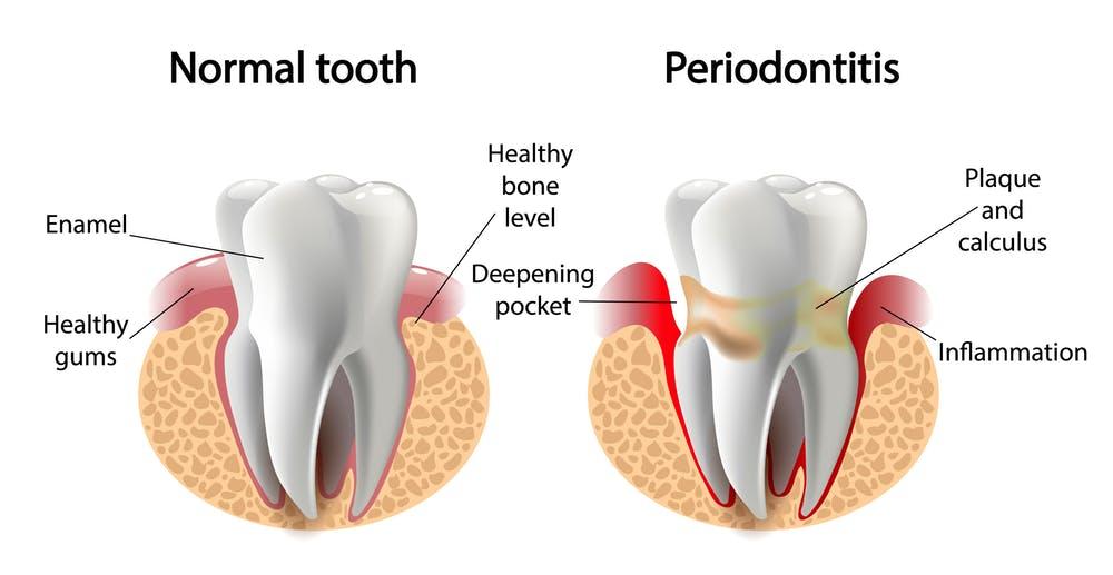 dental implants clinic in Delhi