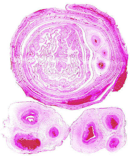 Large uterine decidual artery with minimal cytotrophoblast infiltration at its outside