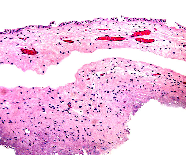 The allantoic sac is above, with single-layered epithelium and numerous blood vessels. The amnion has degenerated epithelium and moderate round cell infiltration