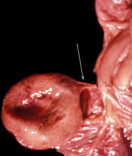 Same acardiac fetus with arrow showing the two vascular connections to normal twin that are necessary for the reversed blood flow