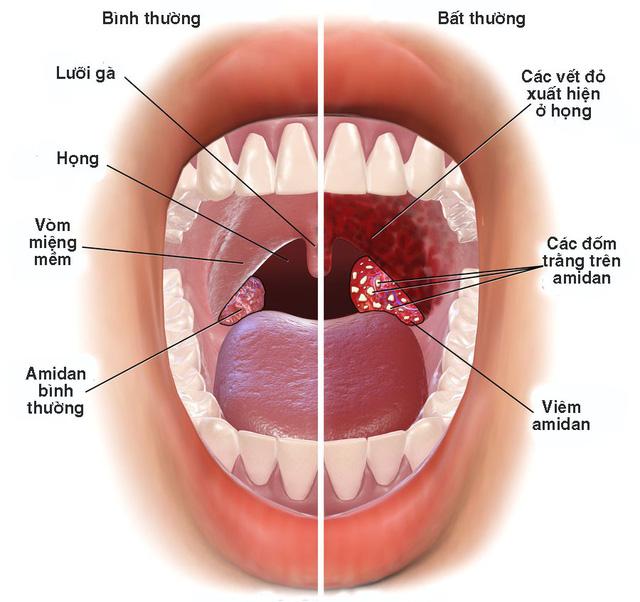 Viêm amidan cấp tính