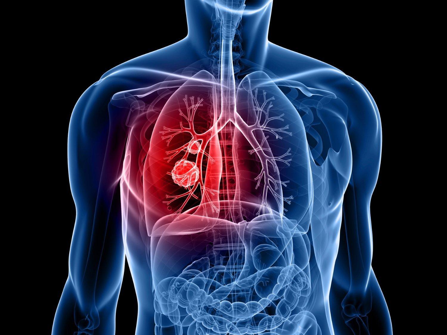 Nếu người bệnh biết được những tiên lượng về khả năng sống sau khi mắc ung thư phổi, sẽ có được cách phòng ngừa, thay đổi lối sống và chăm sóc điều trị tốt hơn.
