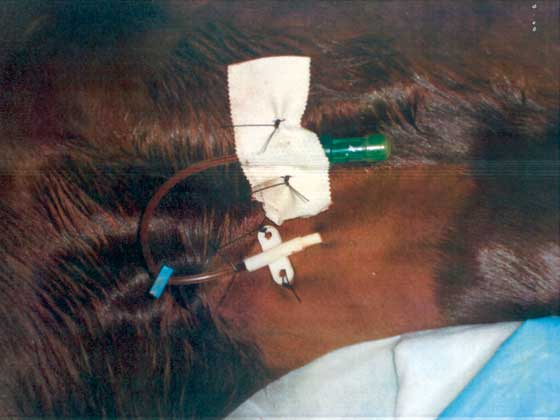 Sutures in place to secure the catheter. 