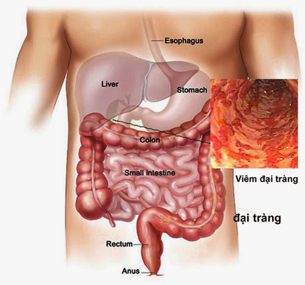 Bệnh Lý Viêm Đại Tràng: Nguyên Nhân, Biểu Hiện Và Các Cách Chữa Tốt Nhất |  Trung tâm Y tế Hòa Vang