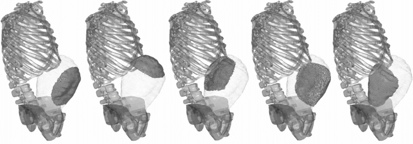 The five simulated placenta positions (from left to right: anterior, superior, posterior, lateral left and lateral right). 