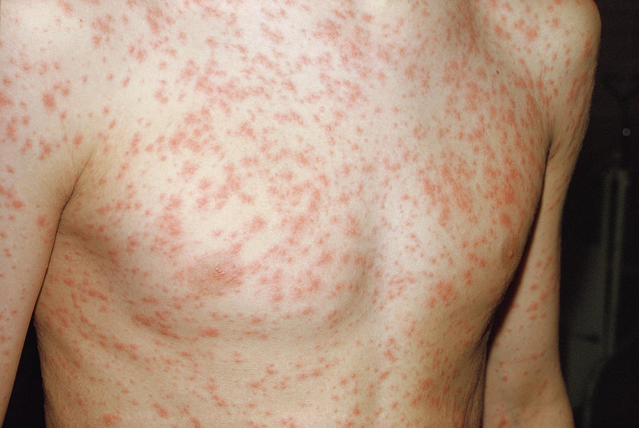 A spread out red rash on a person's upper body.