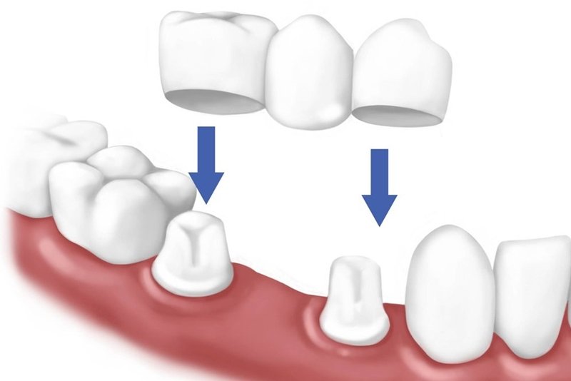 Cầu răng sứ là một trong các cách phục hình răng đã mất hiệu quả