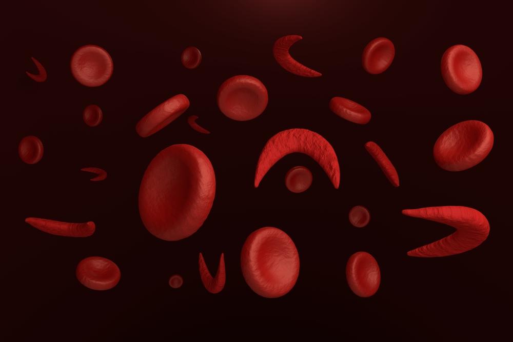 Bệnh thiếu máu hồng cầu hình liềm: Nguyên nhân, triệu chứng và điều trị