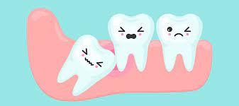 The 411 on Impacted Wisdom Teeth – Cunning Dental Group