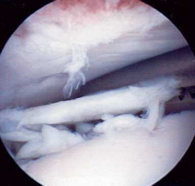 Arthroscopic removal of a cartilage flap from the humeral head