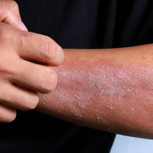 Dermatitis atópica en brazos