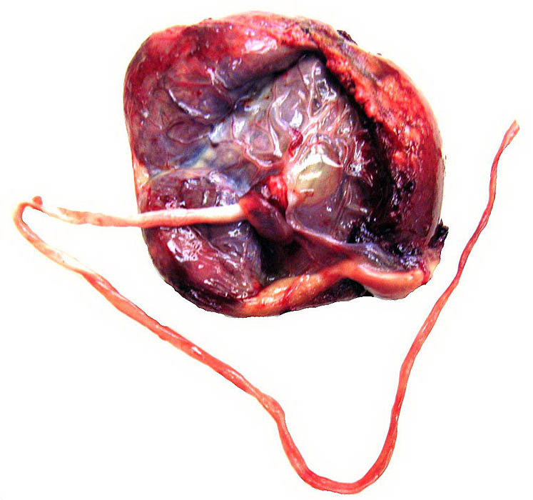 Appearance of the single-disked term placenta