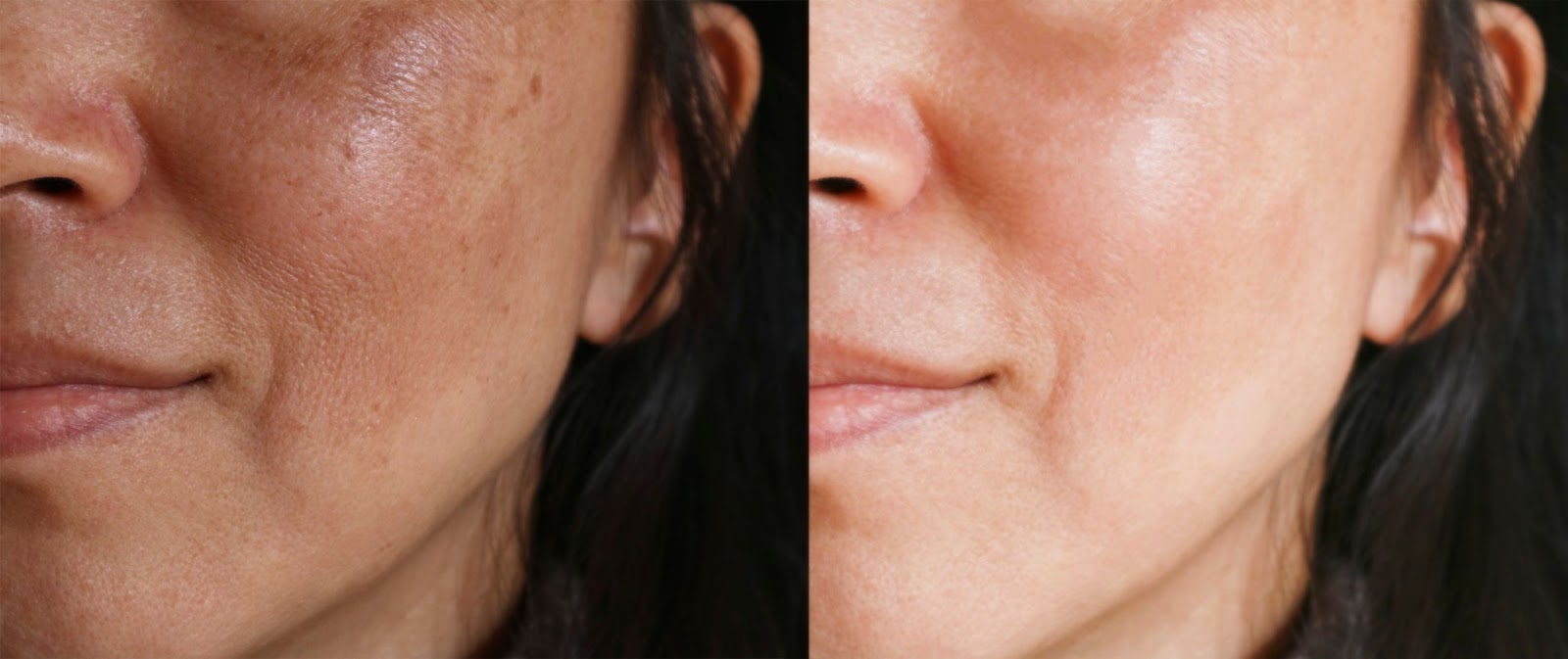 Há duas fotos da mesma pessoa, um antes e depois do tratamento do melasma. A imagem é bem localizada nas bochechas, e na foto da esquerda a mulher possui diversas manchas no rosto, e na foto da direita, é seu rosto após o tratamento. A pele está uniforme, além do desaparecimento das manchas.