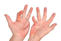What is Dupuytren's contracture