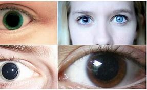 penyakit pada pupil mata - midriasis
