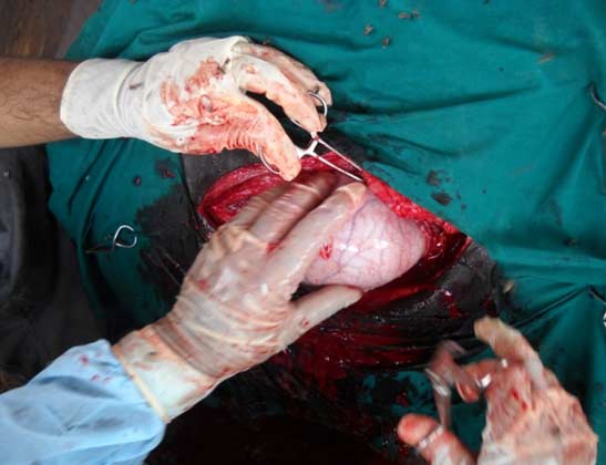 Bringing the uterus up to the operative site by grasping a fetal extremity.