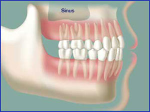 sinus location in human jaw