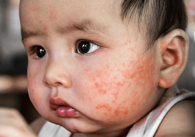 Bệnh tay chân miệng rất nguy hiểm với trẻ nhỏ khi không chữa trị kịp thời