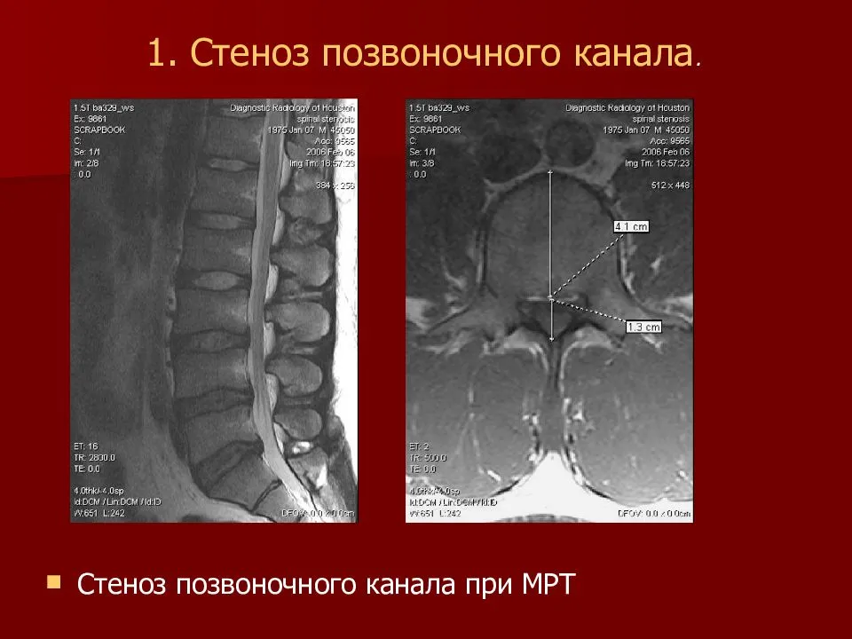 Поясничный абсолютный стеноз