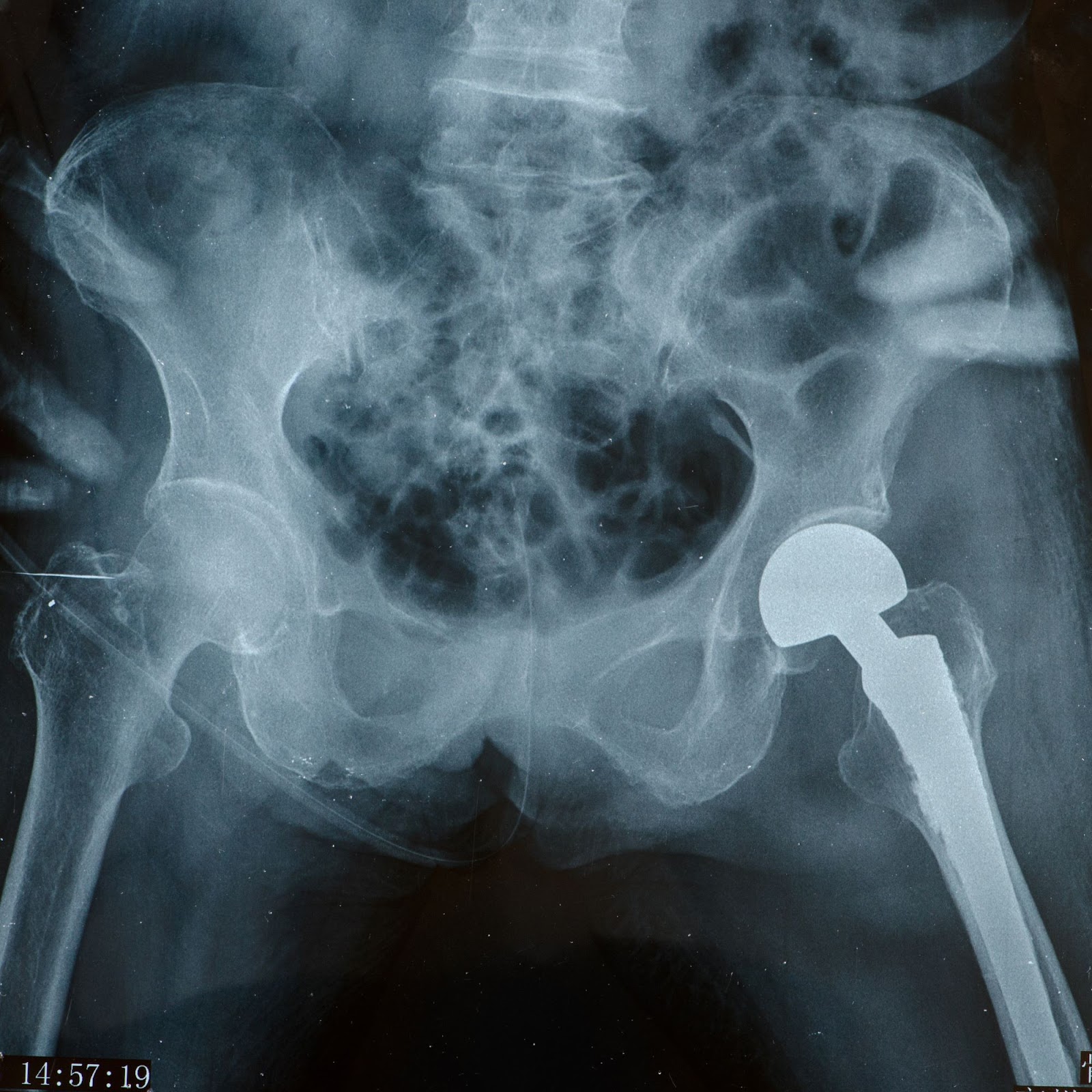 x-ray-of-hip-replacement