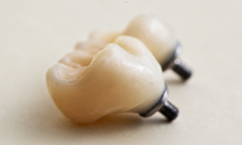 view of two crowns on implants

