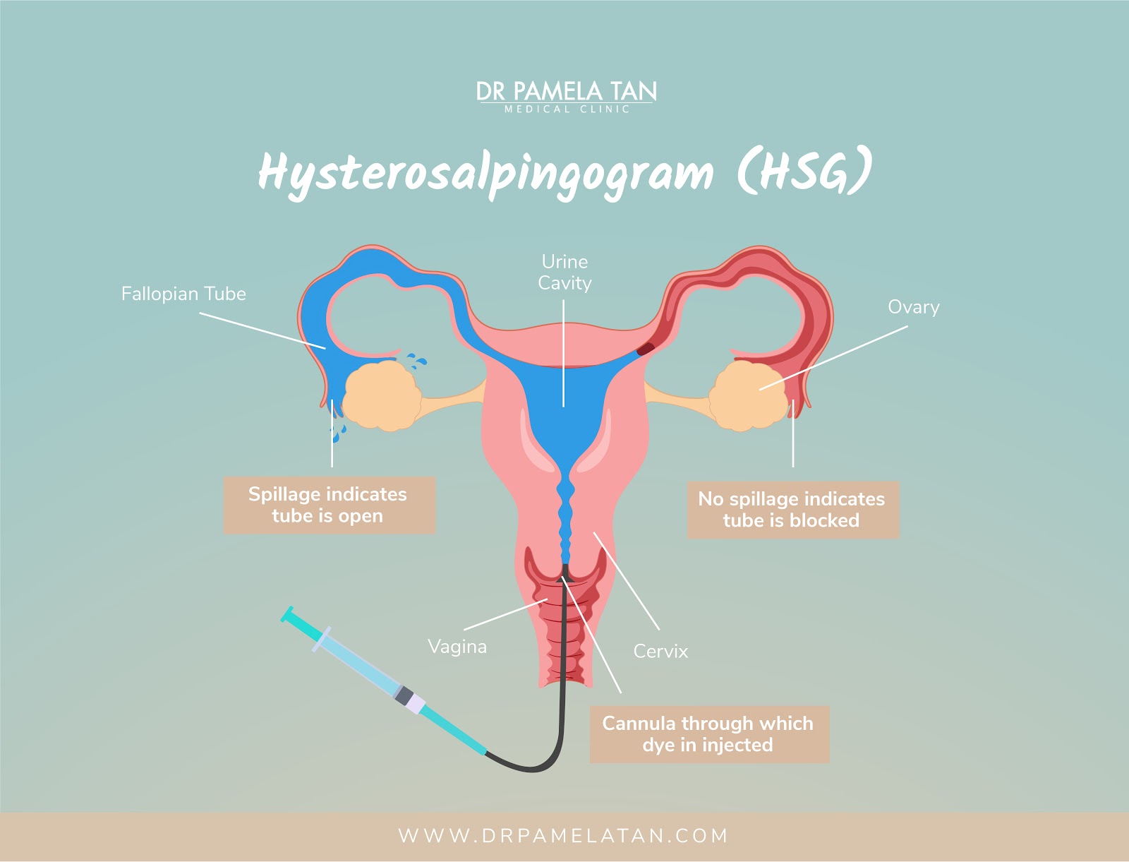 Hysterosalpingogram (HSG)