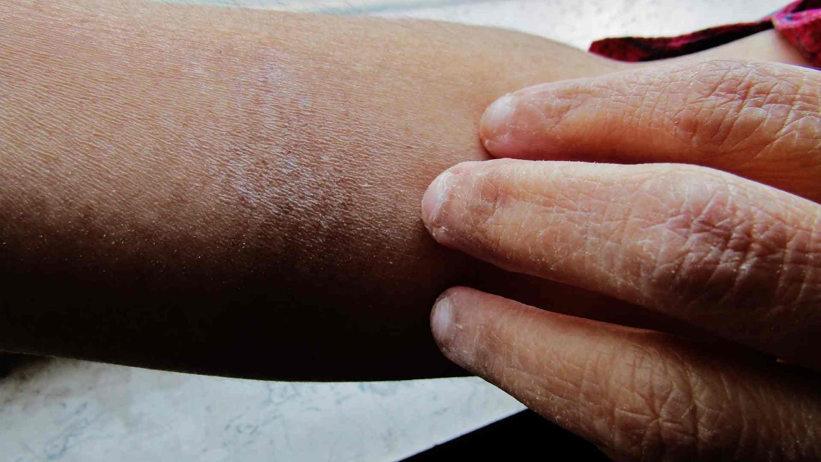 Thin skin is a side effect of prolonged topical steroid use.