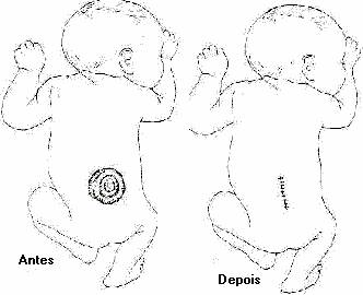 desenho de um bebê na esquerda com a espinha bífida e a direita após a cirurgia de remoção