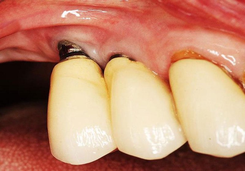 Vị trí cấy Implant bị viêm nhiễm, lộ trụ Implant ra ngoài