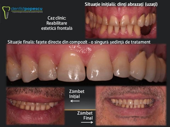 fatere directa compozit