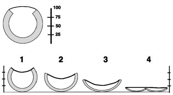 Graphic representation of tracheal collapse grading scheme