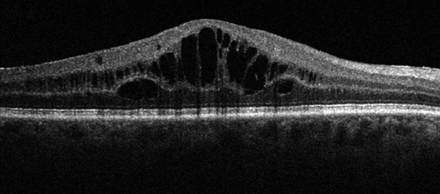 Diabetic retinopathy black and white