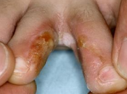 Skin infection pictures and treatments