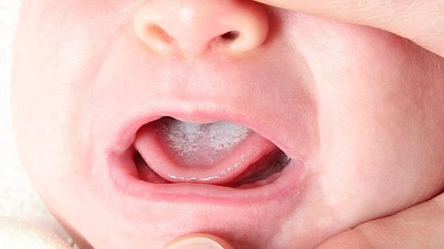 คุณแม่ห้ามพลาด อาการเชื้อราในปากทารก ที่ไม่ควรมองข้าม1