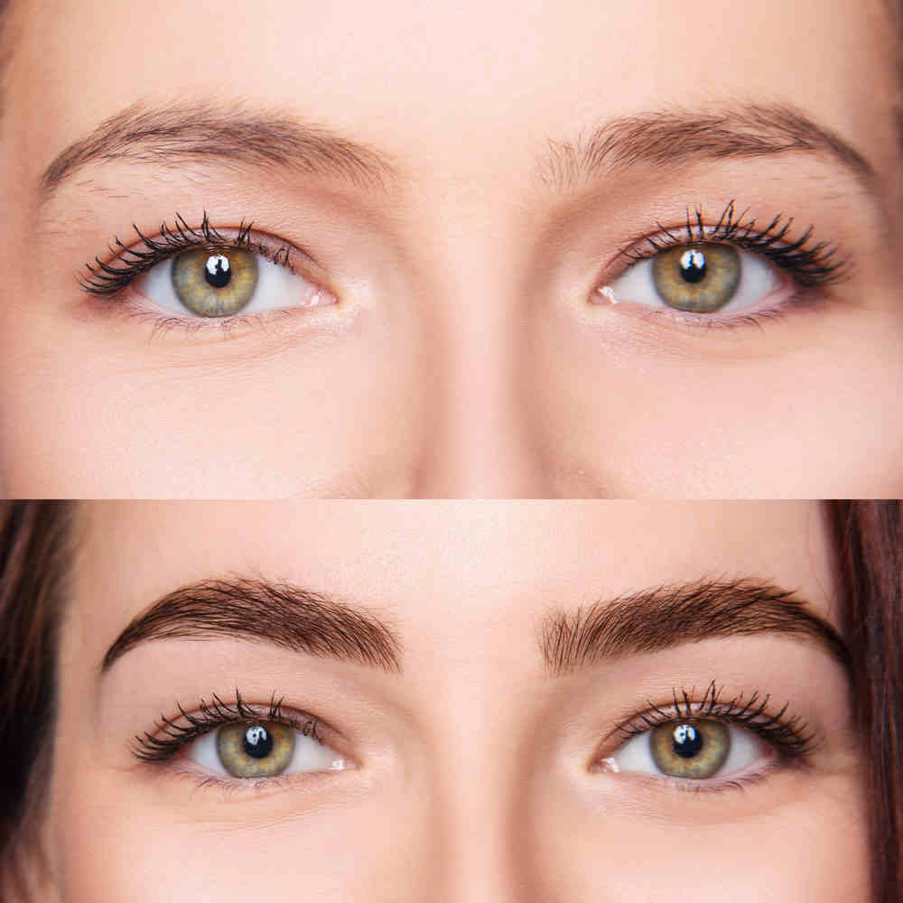 Eyebrow Transplant Before and After Pictures