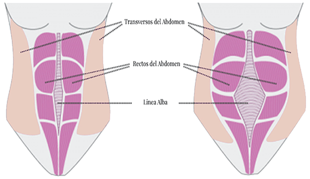 C:\Users\PC\Desktop\Diastasis abdominal 2.png