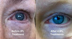 IPL | Advanced Dry Eye Treatment| O'Fallon Family Eyecare
