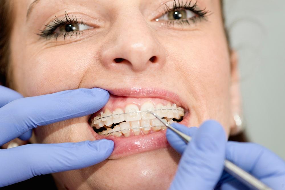What to Expect at Your Orthodontist Appointments | Orthodontic Associates