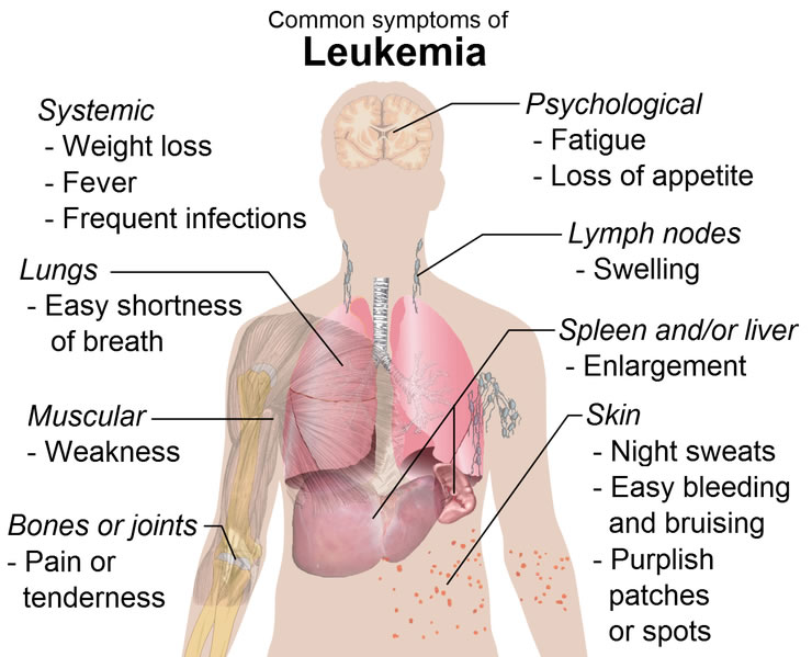 Common symptioms of leukaemia