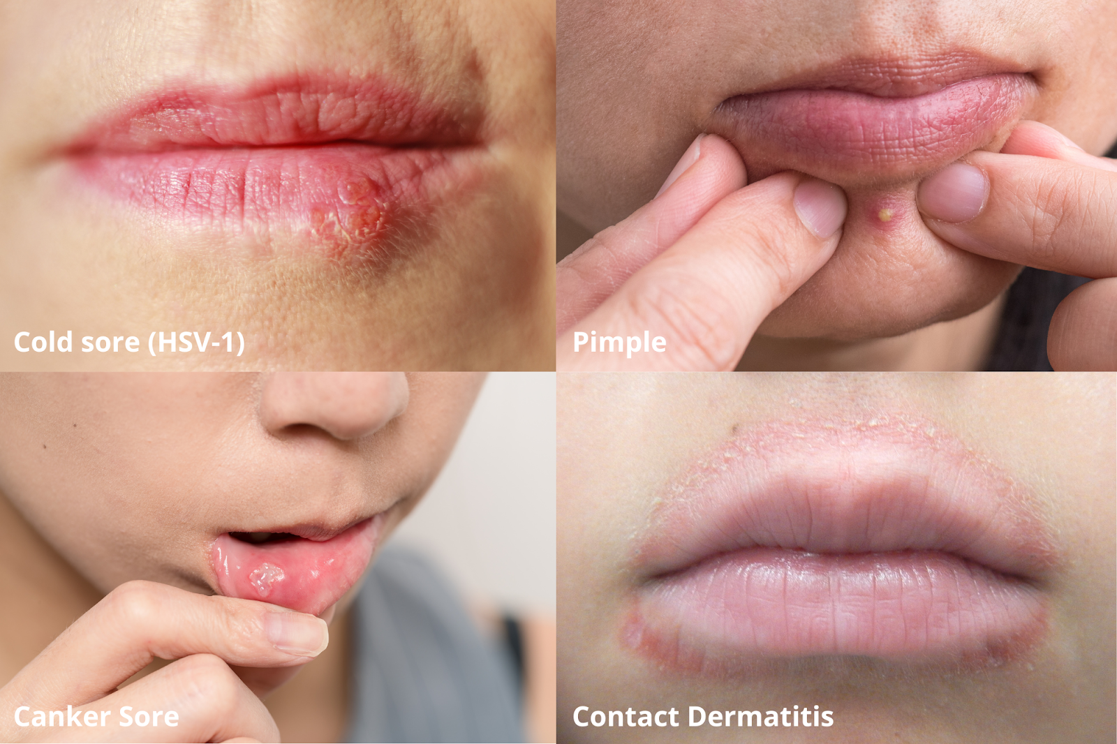 Grid showing a picture of oral herpes infection (cold sore) along with images of other common skin conditions that resemble a cold sore, including a pimple, canker sore, and contact dermatitis.