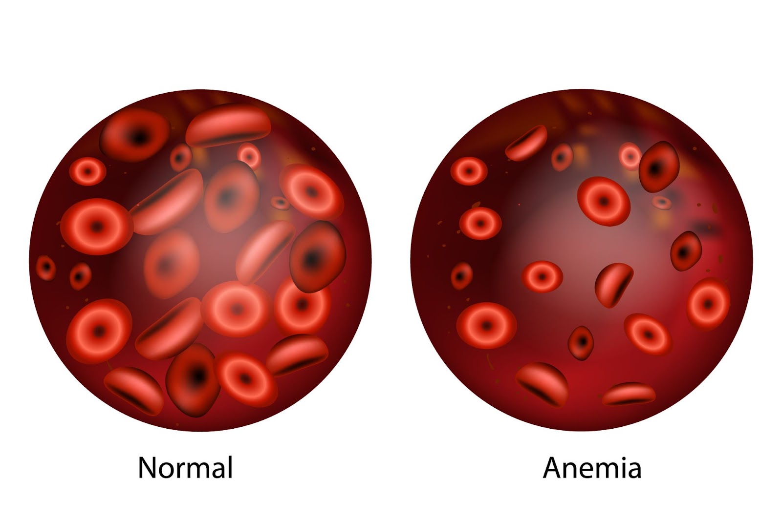 الفرق بين كمية خلايا الدم الحمراء في دم الإنسان السليم والمصاب بأنيميا