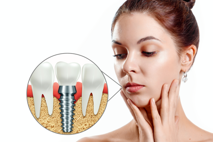 Anatomie implant dentar