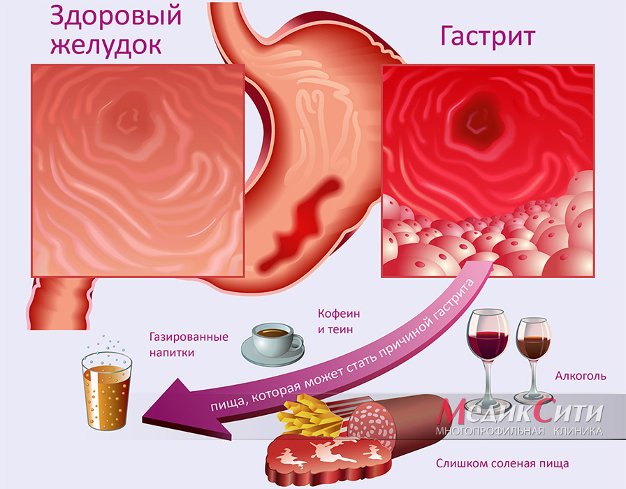 Как лечить гастрит