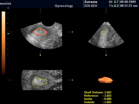 Evaluating Endometrial Thickness in Pregnancy

