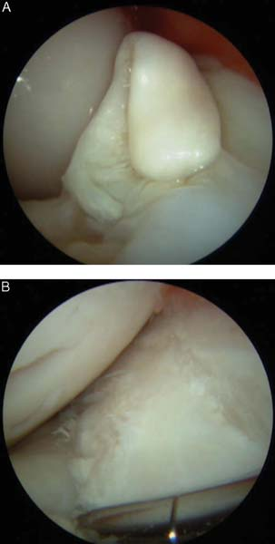 Arthroscopic view of displaced fracture of lateral condyle of distal metacarpus before (A) and after (B) reduction under arthroscopic visualization and internal fixation. 
