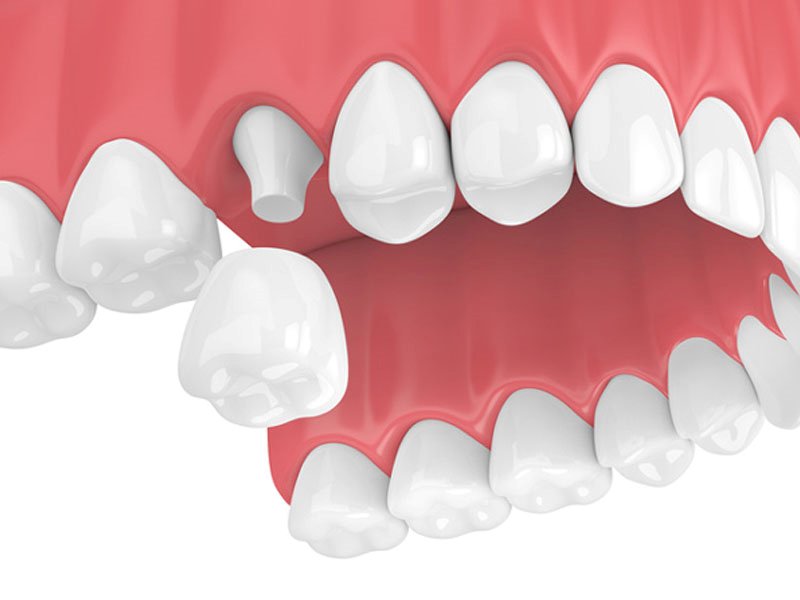 Bọc răng sứ để bảo vệ răng sau khi điều trị tủy